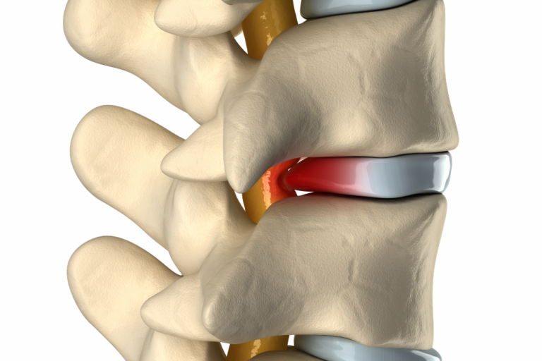 Bulging Disc Settlements In Accident Cases - Real-life Settlement 