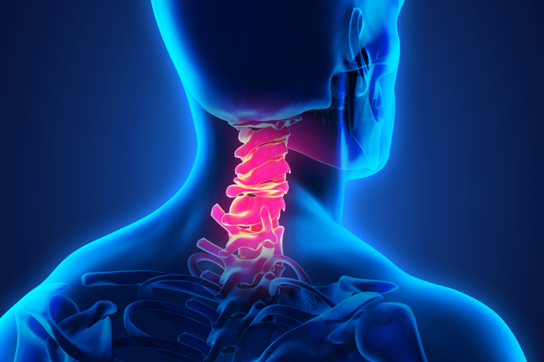 Average Settlement Amounts for Cervical Herniation & Cervical Fusion ...