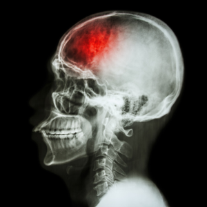 Stroke Misdiagnosis